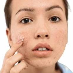 Zinked Acne Pimple Patches - 1% Salicylzuur (BHA) & 1% Zink - 36 Patches - Hydrocolloïd -Essie winkel 550x550 840