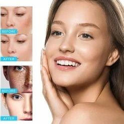 IBeaLee Bruine Vlekken Verwijderen | Sproet Creme | Pigmentvlekken Verwijderaar -Essie winkel 550x589 6